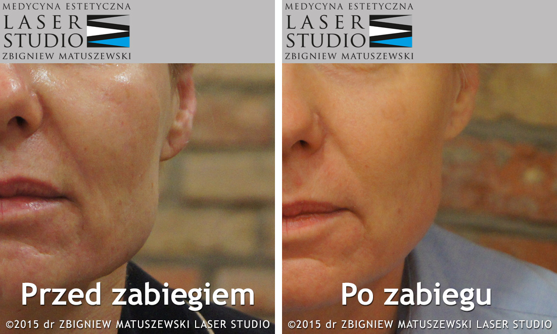 Laserowy lifting twarzy - innowacyjna metoda